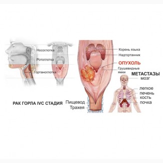 Рак горла, гортани, миндалин. Лечение