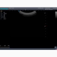 УЗИ/ УЗД SonoScape S2/ Доплер/ Конвексний датчик